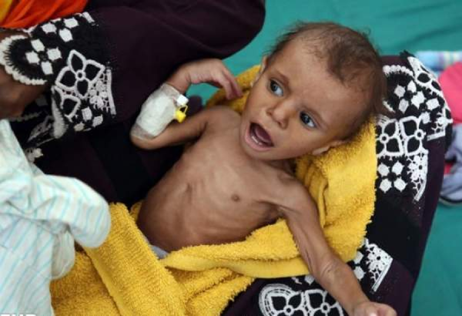 سعودی عرب اور امریکہ کی یمن پر جارحیت کے نتیجے میں کینسر کے مریض بچوں میں اضافہ